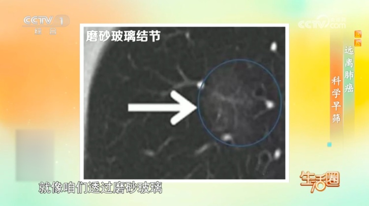 体检查出结节、息肉?先别慌!赶快对照这些关键指标自查→ 体检查出结节、息肉?先别慌!赶快对照这些关键指标自查→