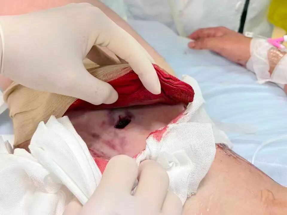 13岁少年大腿被车把穿刺,首都儿童医学中心紧急施救 13岁少年大腿被车把穿刺,首都儿童医学中心紧急施救