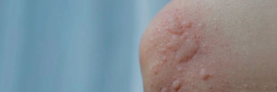 近期高发！这种"蚊子包"，真的别挠！