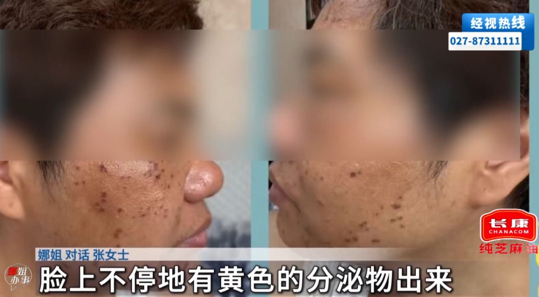 女子去美容店体验276元淡斑套餐,被涂抹不明药水,店员:半小时内不交1万元就会毁容 女子去美容店体验276元淡斑套餐,被涂抹不明药水,店员:半小时内不交1万元就会毁容