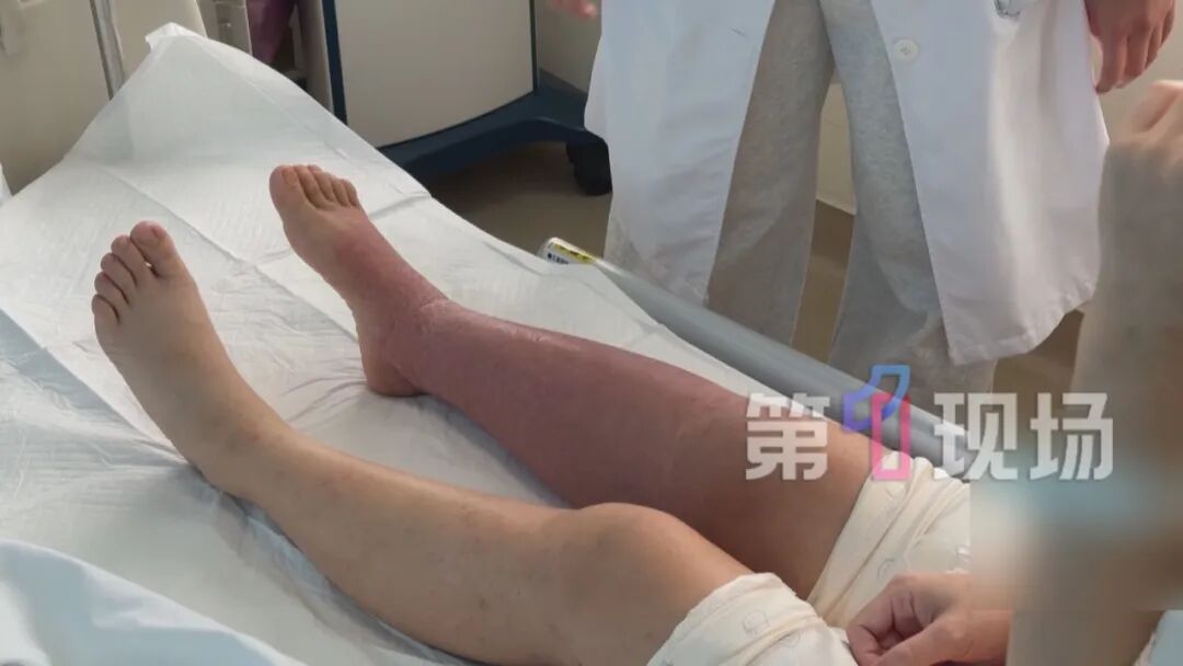 咋这样?为治湿疹忌口三个月,女子腿肿成“猪蹄”! 咋这样?为治湿疹忌口三个月,女子腿肿成“猪蹄”!