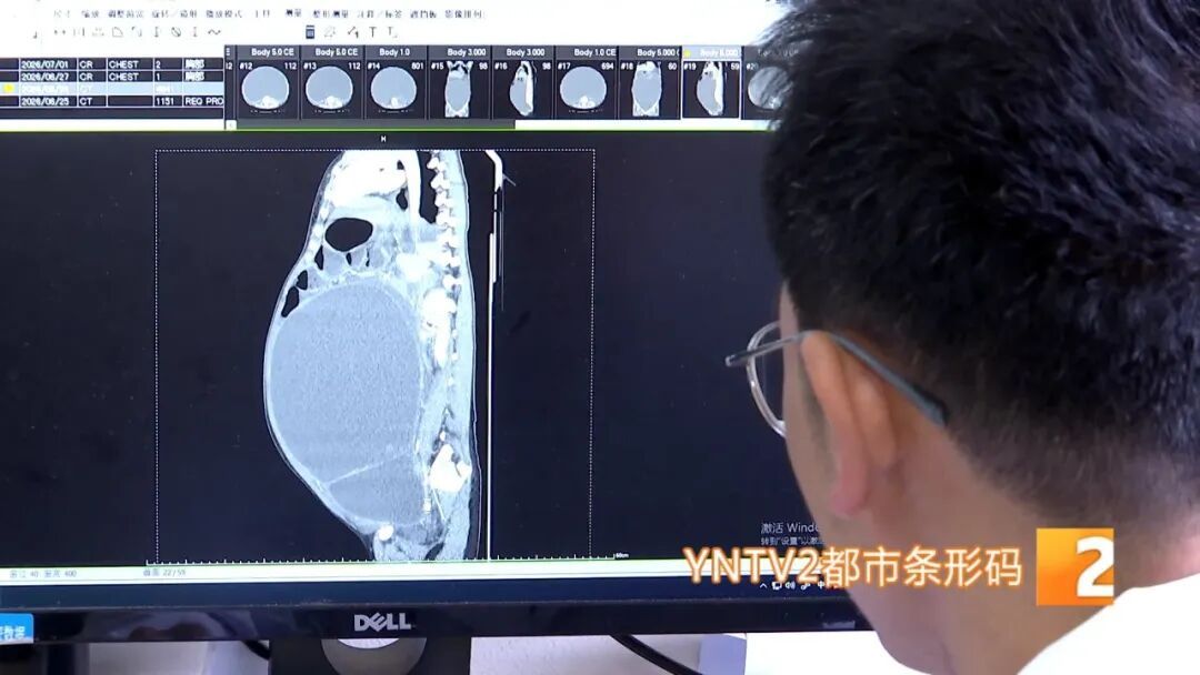 被误会怀孕三年!云南24岁女子腹部隆起比篮球还大,手术取出15公斤巨大囊肿 被误会怀孕三年!云南24岁女子腹部隆起比篮球还大,手术取出15公斤巨大囊肿