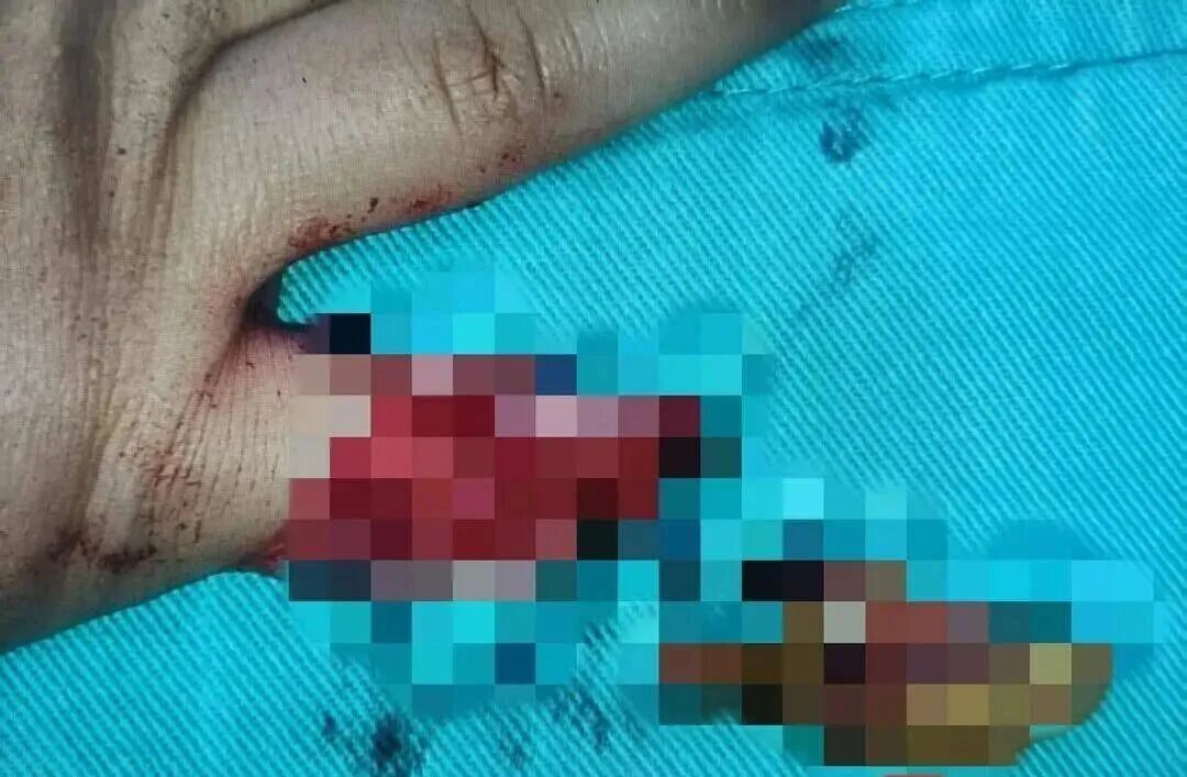“爸爸我的手指没了!”2岁女童在商场被夹断小拇指,辗转三地接指 “爸爸我的手指没了!”2岁女童在商场被夹断小拇指,辗转三地接指