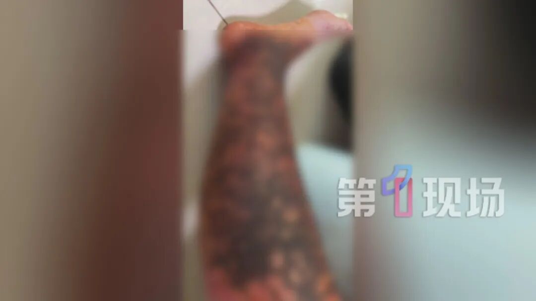 咋这样?为治湿疹忌口三个月,女子腿肿成“猪蹄”! 咋这样?为治湿疹忌口三个月,女子腿肿成“猪蹄”!