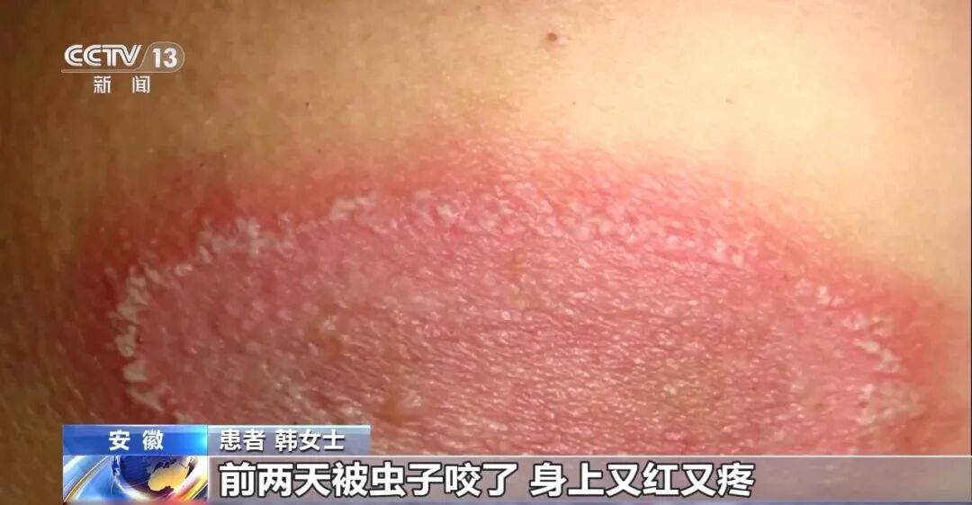 毒液堪比硫酸!近期高发活跃,这种虫子千万别用手拍 毒液堪比硫酸!近期高发活跃,这种虫子千万别用手拍