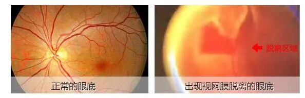 离谱!男子迷信“右眼跳灾”,狂拍眼周去晦气,差点失明 离谱!男子迷信“右眼跳灾”,狂拍眼周去晦气,差点失明