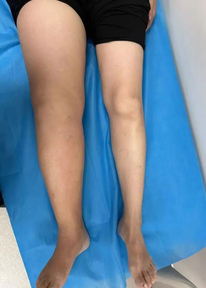 广东一女子右腿肌肉酸痛,用自制“辣油”贴敷腿,腿肿如象腿,皮肤硬如象皮 广东一女子右腿肌肉酸痛,用自制“辣油”贴敷腿,腿肿如象腿,皮肤硬如象皮