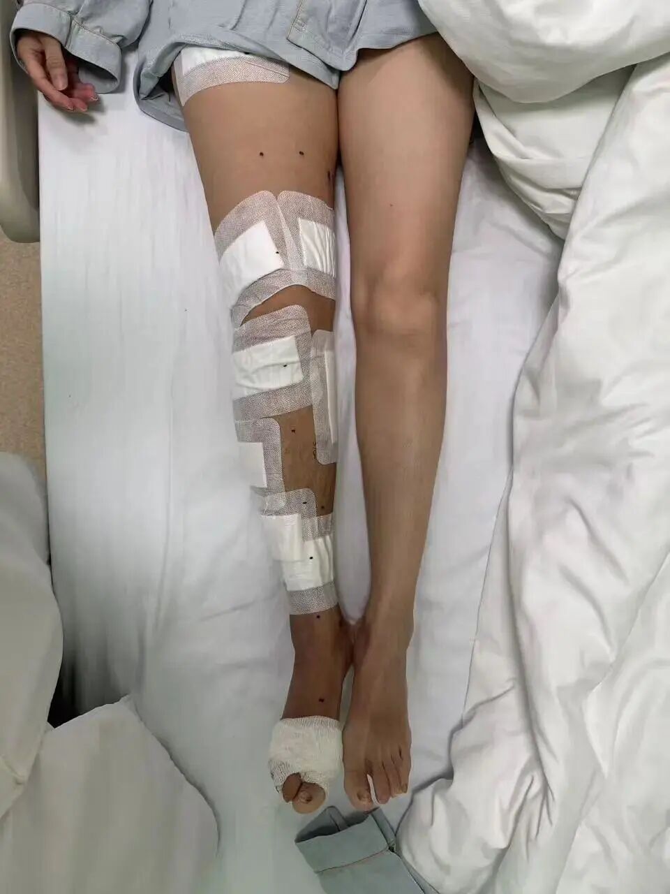 广东一女子右腿肌肉酸痛,用自制“辣油”贴敷腿,腿肿如象腿,皮肤硬如象皮 广东一女子右腿肌肉酸痛,用自制“辣油”贴敷腿,腿肿如象腿,皮肤硬如象皮