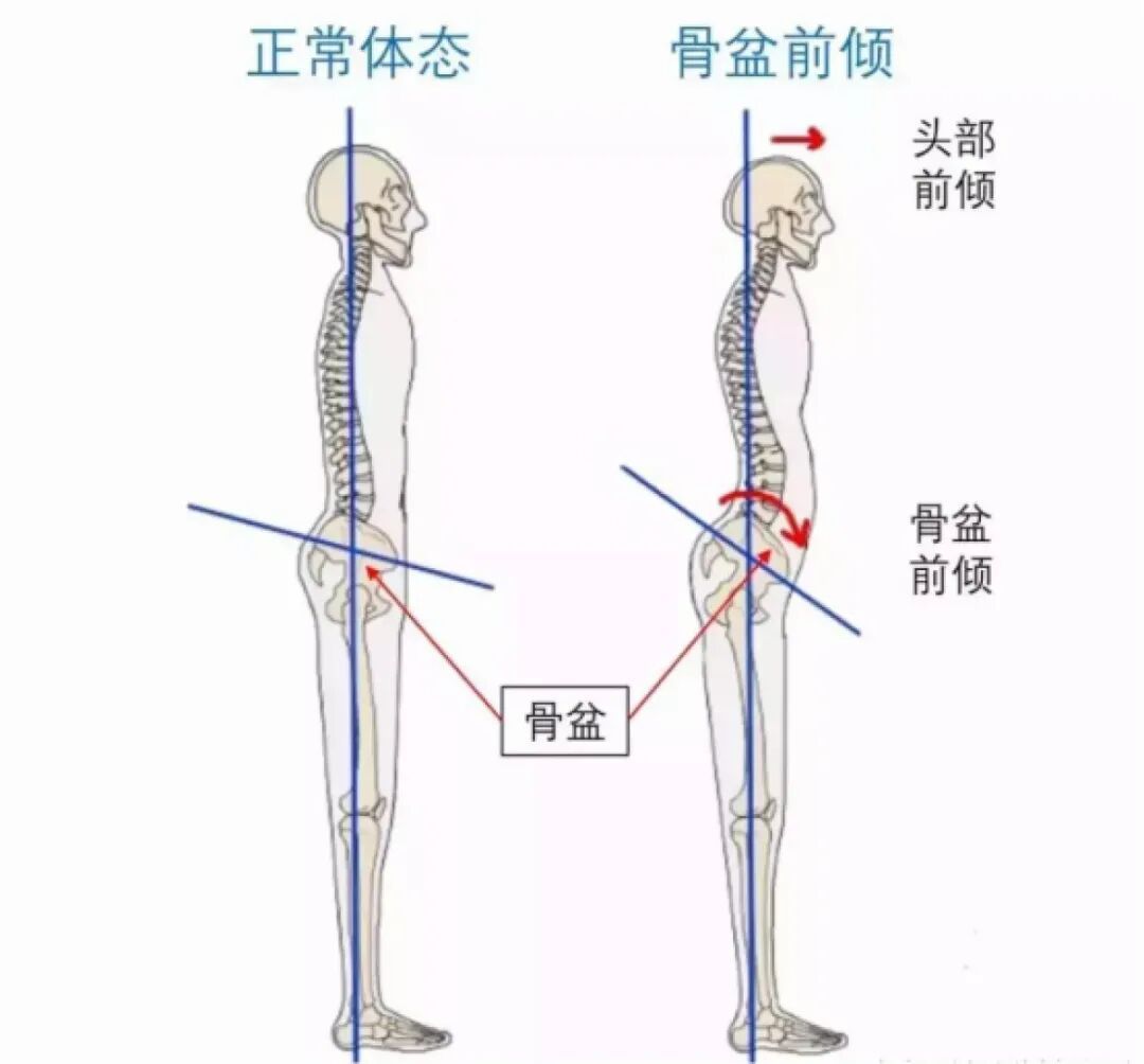 模仿球星哈兰德标志性前倾体态?看着帅气,长期照搬暗藏颈椎健康隐患 模仿球星哈兰德标志性前倾体态?看着帅气,长期照搬暗藏颈椎健康隐患