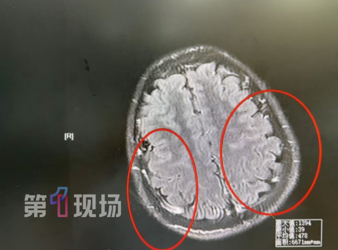 “差点没命！”24岁小伙连续熬夜后感冒，被送进ICU