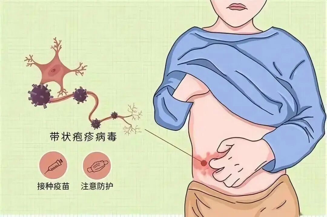 30岁女子嘴角长水疱未重视,竟脑死亡! 医生:近期高发,极易传染,千万别当是上火 30岁女子嘴角长水疱未重视,竟脑死亡! 医生:近期高发,极易传染,千万别当是上火