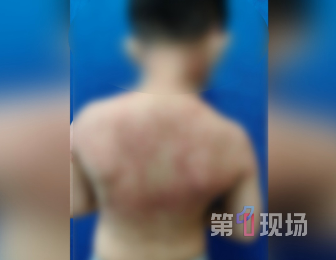 多个孩子接连“中招”,又痒又疼还脱皮! 多个孩子接连“中招”,又痒又疼还脱皮!