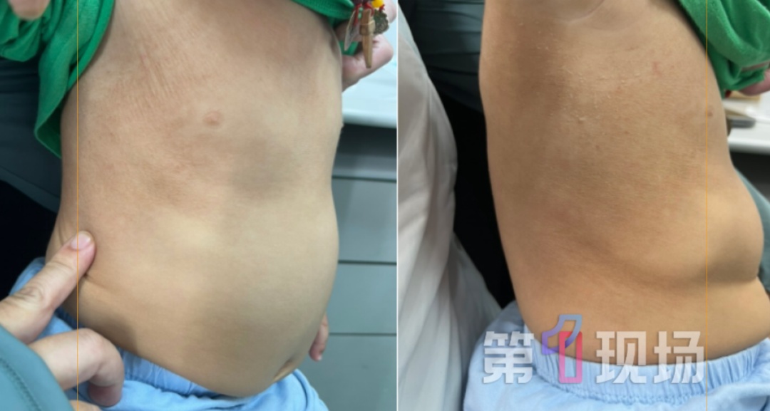 多个孩子接连“中招”,又痒又疼还脱皮! 多个孩子接连“中招”,又痒又疼还脱皮!