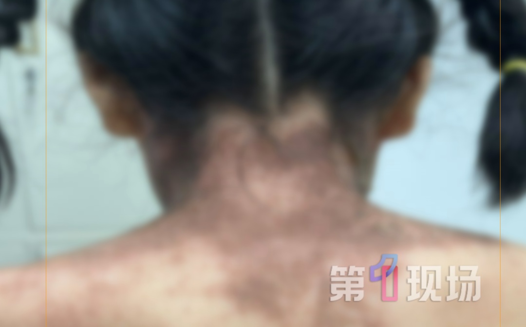 多个孩子接连“中招”,又痒又疼还脱皮! 多个孩子接连“中招”,又痒又疼还脱皮!