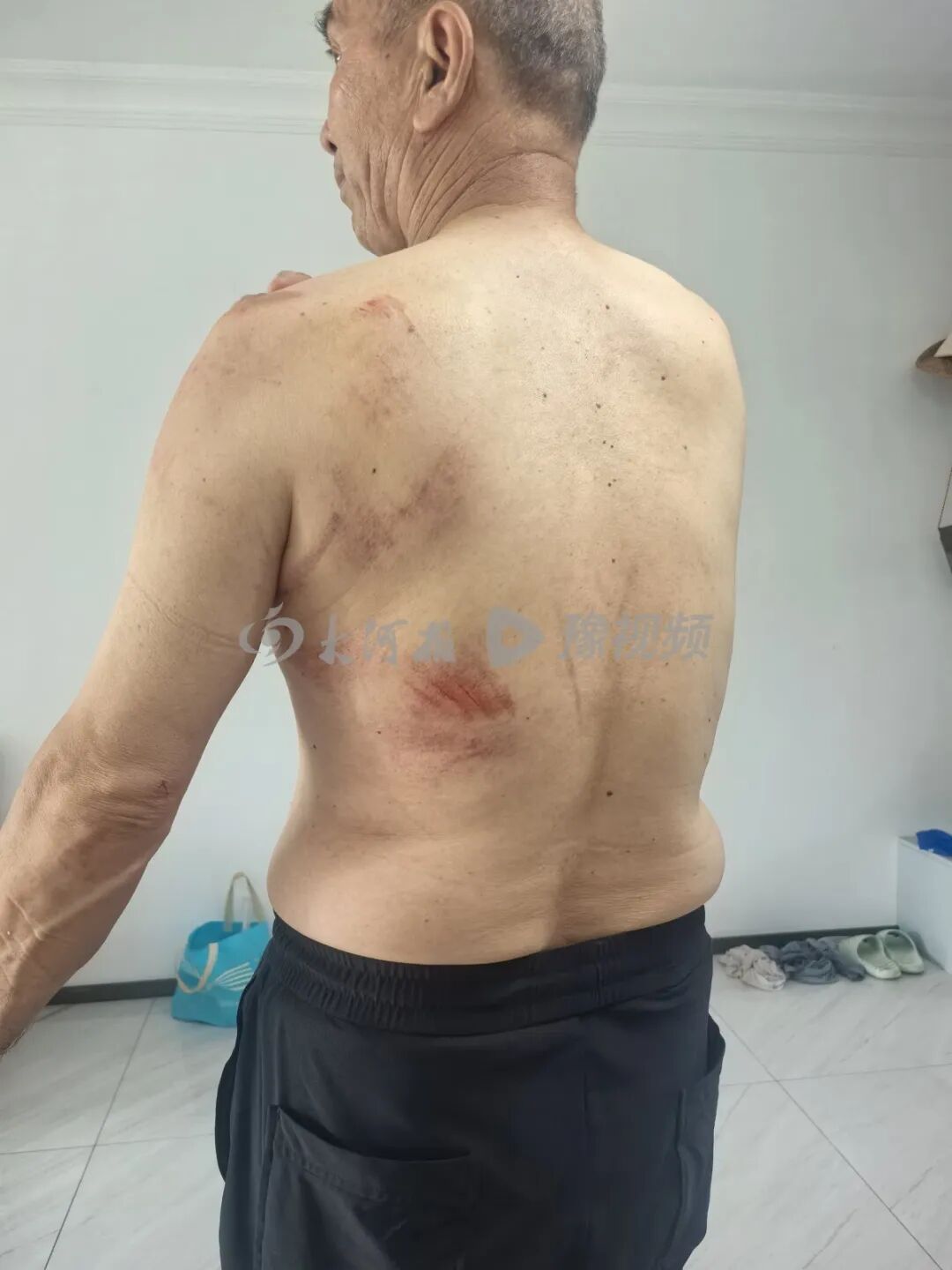 新疆一儿童意外坠井,62岁大爷绳结绑身下井救人,全身多处刮伤,手机也泡坏了,儿子:又揪心又光荣,我爹做了件大事,我得给他宣传宣传 新疆一儿童意外坠井,62岁大爷绳结绑身下井救人,全身多处刮伤,手机也泡坏了,儿子:又揪心又光荣,我爹做了件大事,我得给他宣传宣传