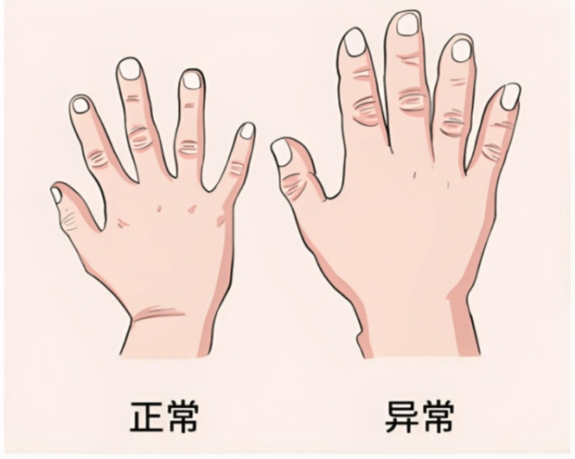这种“胖”不是吃太多,是脑部肿瘤的信号 这种“胖”不是吃太多,是脑部肿瘤的信号