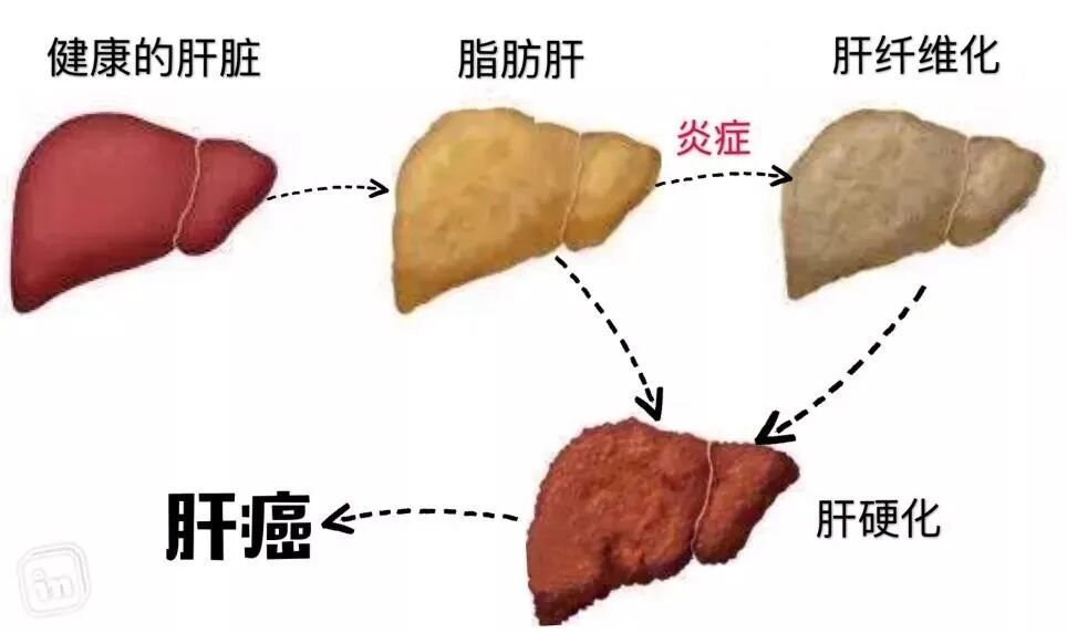 身上挂着三颗“炸弹”,男子肚子胀得像气球,医生提醒:危及生命! 身上挂着三颗“炸弹”,男子肚子胀得像气球,医生提醒:危及生命!