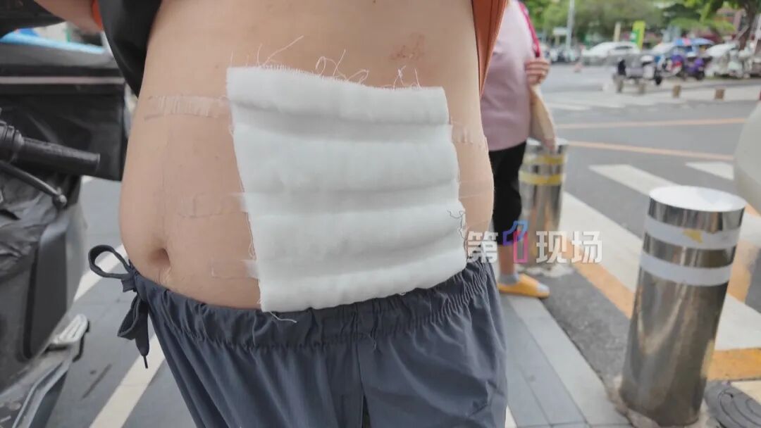 路上摔了一跤,外卖小哥被大面积烧伤!类似事件发生过好几次…… 路上摔了一跤,外卖小哥被大面积烧伤!类似事件发生过好几次……