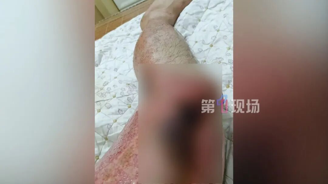 路上摔了一跤,外卖小哥被大面积烧伤!类似事件发生过好几次…… 路上摔了一跤,外卖小哥被大面积烧伤!类似事件发生过好几次……