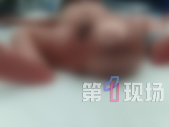 刚出生女婴屁股长巨大肿瘤,“有拳头那么大”,挤压多个脏器!医生提醒 刚出生女婴屁股长巨大肿瘤,“有拳头那么大”,挤压多个脏器!医生提醒