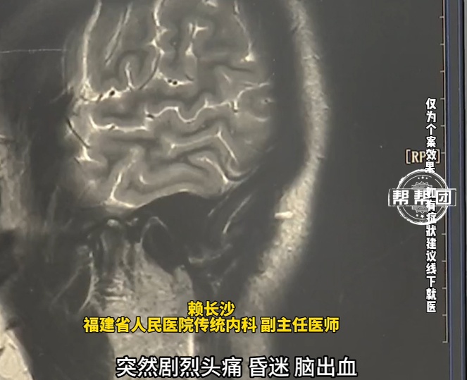 绿豆汤当水连喝三天，女子血压飙升，突发脑出血昏迷！医生提醒