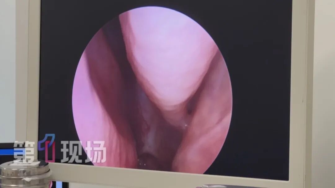 9岁女童一个动作面部流脓,差点毁容!很多人不自觉会做,紧急提醒:严重可致命 9岁女童一个动作面部流脓,差点毁容!很多人不自觉会做,紧急提醒:严重可致命