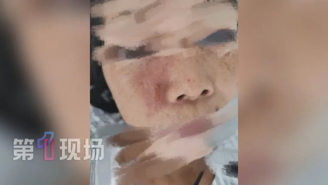 9岁女童一个动作面部流脓,差点毁容!很多人不自觉会做,紧急提醒:严重可致命 9岁女童一个动作面部流脓,差点毁容!很多人不自觉会做,紧急提醒:严重可致命