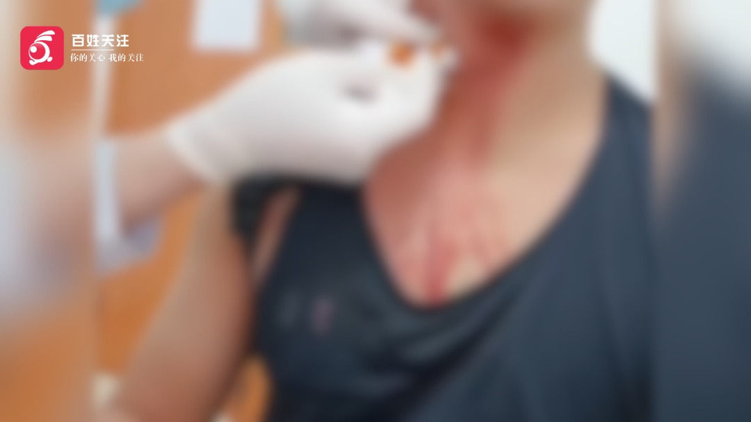 差点被蚊子“单杀”!男子拍打蚊子结果拍破颈部静脉:血流不止按压无效 差点被蚊子“单杀”!男子拍打蚊子结果拍破颈部静脉:血流不止按压无效