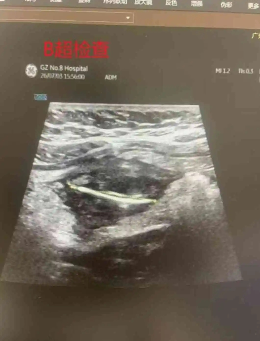 “再也不敢边吃饭边看手机了” 广州一女子误吞一次性筷子小竹片,肠管被刺破 “再也不敢边吃饭边看手机了” 广州一女子误吞一次性筷子小竹片,肠管被刺破