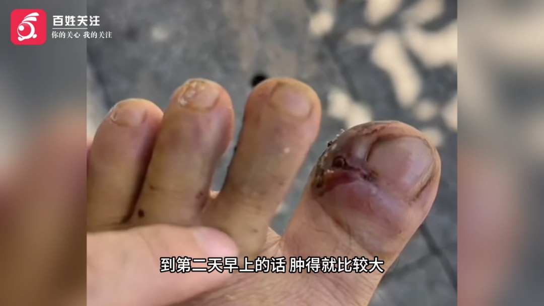 四川一男子被毒蛇咬伤,脚趾肿大溃烂,驱车500公里到贵州寻医治疗 四川一男子被毒蛇咬伤,脚趾肿大溃烂,驱车500公里到贵州寻医治疗