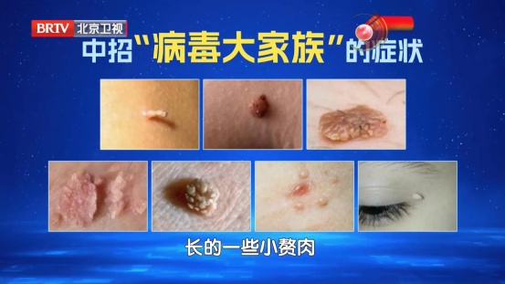 大部分女性都躲不过的病毒,反复感染易癌变,两个高危年龄段尤其要注意...... 大部分女性都躲不过的病毒,反复感染易癌变,两个高危年龄段尤其要注意......