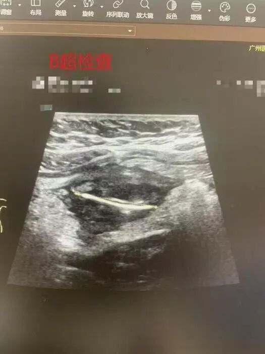 广州20岁女子边吃饭边看手机,无意中吞下两根竹筷片,反复发烧腹痛还以为是感冒了 广州20岁女子边吃饭边看手机,无意中吞下两根竹筷片,反复发烧腹痛还以为是感冒了