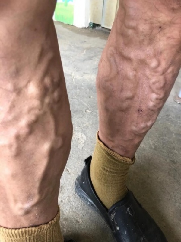 走着走着，腿部突然爆血管！男子瘫坐路边血流不止，深圳铁骑迅速出手→