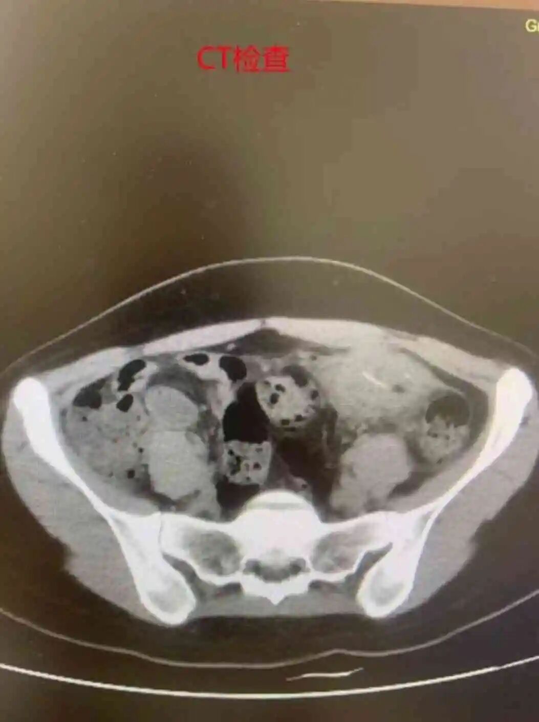 广州一女子腹腔中取出一次性筷子竹片,直呼“再也不敢边吃饭边看手机”…… 广州一女子腹腔中取出一次性筷子竹片,直呼“再也不敢边吃饭边看手机”……