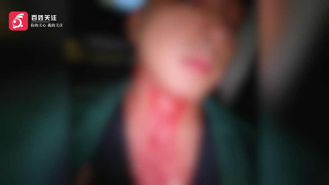 男子颈部被蚊子叮了一口,竟流血400毫升!网友:差点被蚊子"单杀" 男子颈部被蚊子叮了一口,竟流血400毫升!网友:差点被蚊子"单杀"