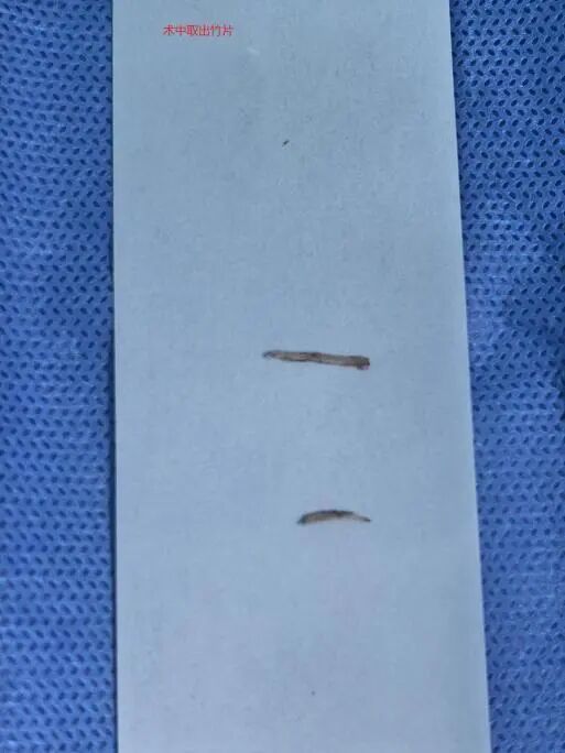 广州20岁女子边吃饭边看手机,无意中吞下两根竹筷片,反复发烧腹痛还以为是感冒了 广州20岁女子边吃饭边看手机,无意中吞下两根竹筷片,反复发烧腹痛还以为是感冒了