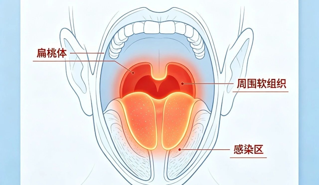 一个月接诊15例!女子以为是感冒,嗓子却像被刀片刮过......医生提醒→ 一个月接诊15例!女子以为是感冒,嗓子却像被刀片刮过......医生提醒→