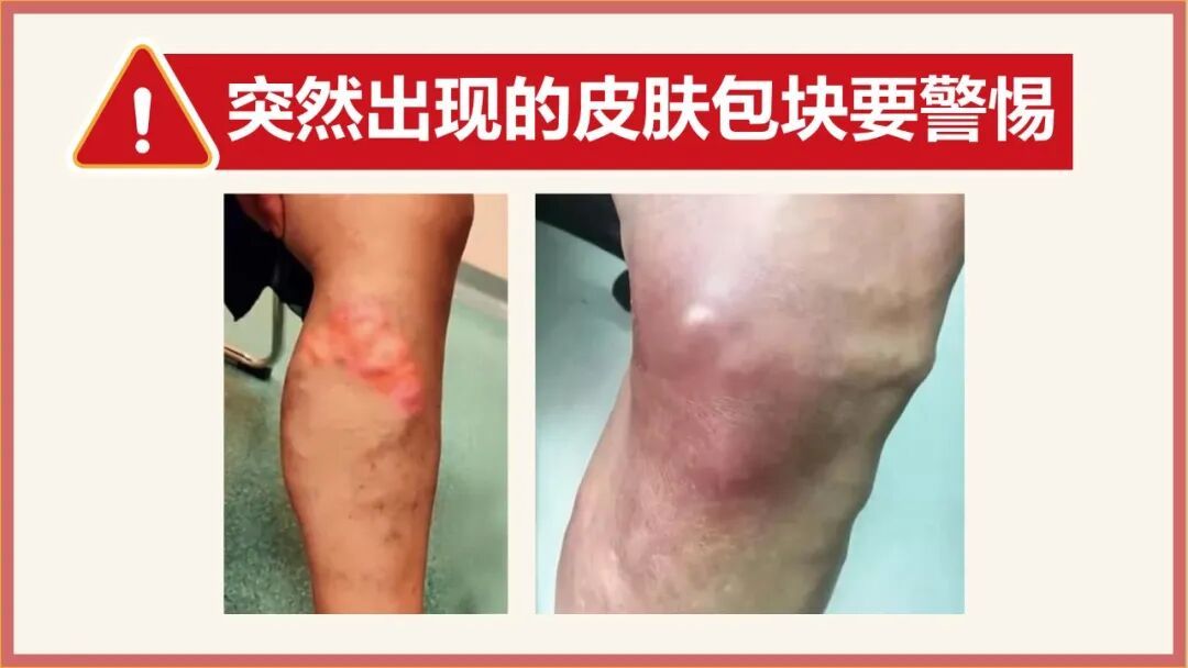 血栓就“怕”你这样动，常做气血通了、血管不堵，久坐、三高人群更要练
