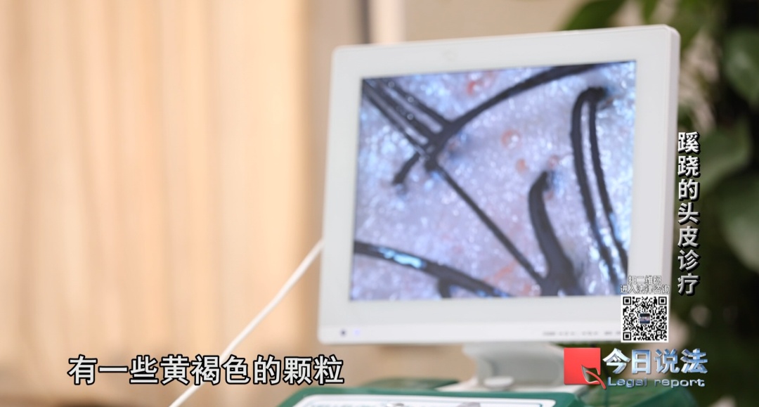 洗个头花2万!理发检出“虫卵”和红疹,吓蒙了…… 洗个头花2万!理发检出“虫卵”和红疹,吓蒙了……