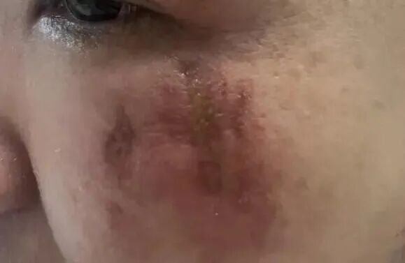 杭州又有人中招！紧急提醒：千万别拍这种虫子