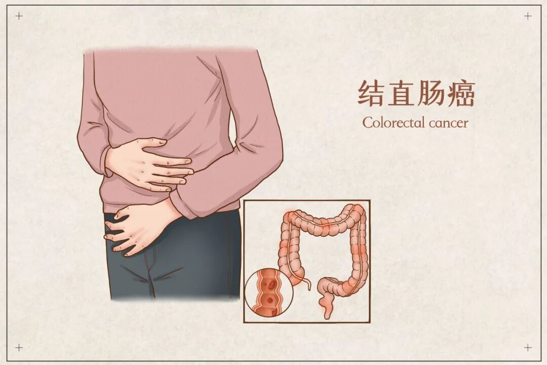 远离结直肠癌,出现这些症状须警惕,哪些人群为高危人群 远离结直肠癌,出现这些症状须警惕,哪些人群为高危人群