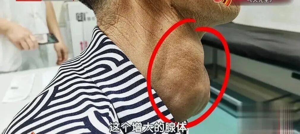 又一个甲状腺癌“帮凶”被发现？身体这些表现是甲状腺在“求救”