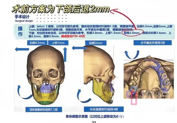 “24岁女孩正颌手术被做反”，武汉大学口腔医院通报：当事医生已停诊