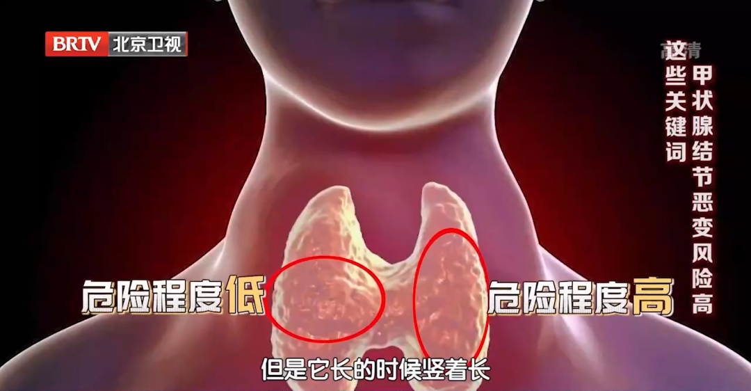 又一个甲状腺癌“帮凶”被发现？身体这些表现是甲状腺在“求救”