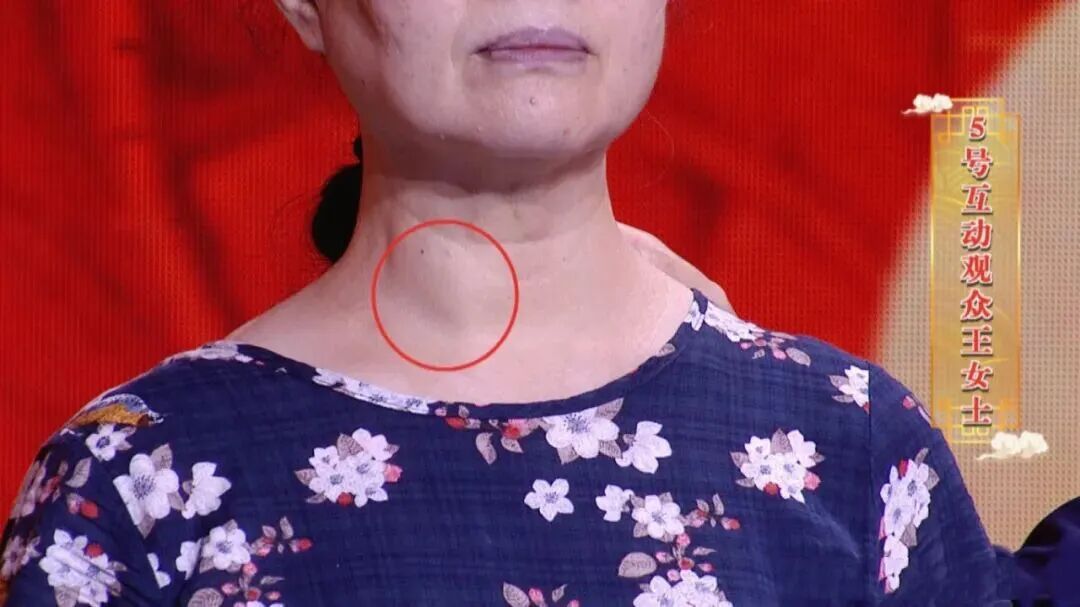 又一个甲状腺癌“帮凶”被发现？身体这些表现是甲状腺在“求救”