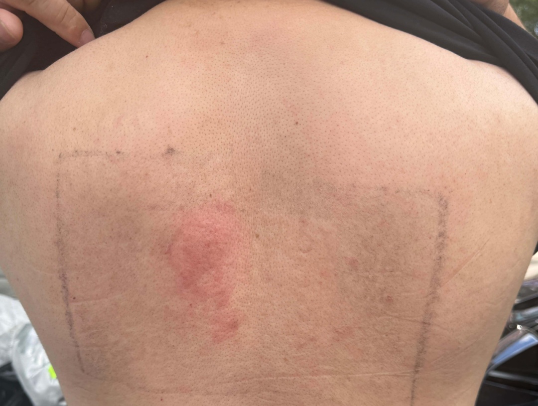 “不分场合、说来就来!”浙江45岁男子每年夏天都要遭遇肚皮瘙痒尴尬,医生:皮带过敏 “不分场合、说来就来!”浙江45岁男子每年夏天都要遭遇肚皮瘙痒尴尬,医生:皮带过敏