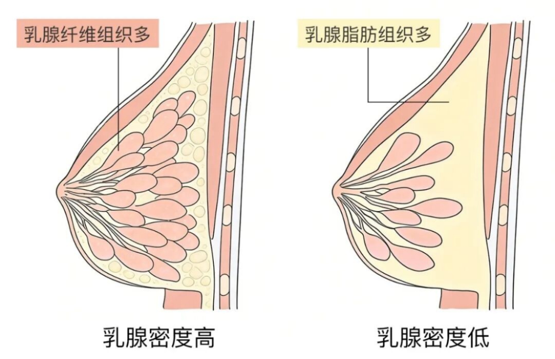乳腺癌和胸部大小相关?“危险信号”看这里... 乳腺癌和胸部大小相关?“危险信号”看这里...
