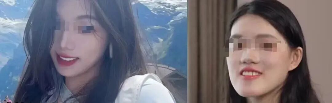 24岁女孩做正颌手术被整成“鞋拔子脸”!医疗美容中医疗事故的界限究竟如何划定? 24岁女孩做正颌手术被整成“鞋拔子脸”!医疗美容中医疗事故的界限究竟如何划定?