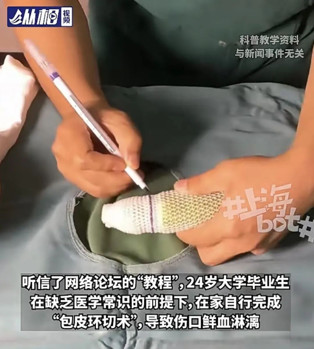 上海一小伙听信网络“教程”，居家自行“包皮环切术”，无麻醉无消毒，伤口鲜血淋漓