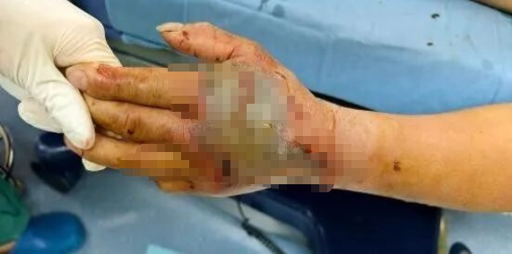 大爷杀死剧毒眼镜蛇,5分钟后离断蛇头突然“复仇”……医生提醒 大爷杀死剧毒眼镜蛇,5分钟后离断蛇头突然“复仇”……医生提醒